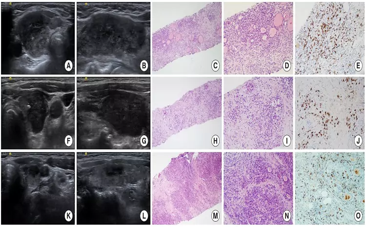 gil birmingham thyroid disease